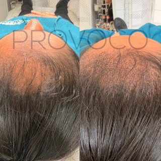 1 session in … 2 to go! 📈 #smp #scalpmicropigmentation #haircoverage #londonsmp