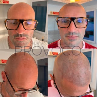 Results after 2 sessions! 📈🔥 #scalpmicropigmentation #smp