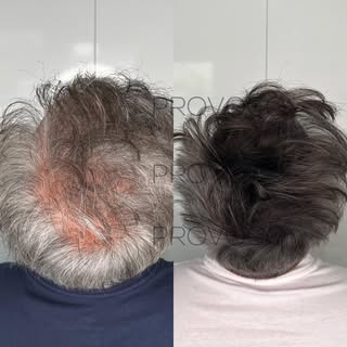 Confidence starts with a natural finish 💯 #scalpmicropigmentation #smp