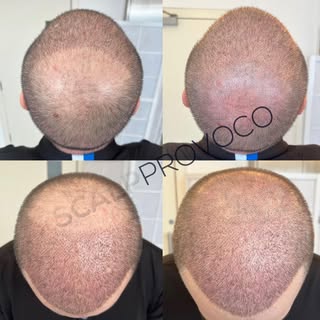 SMP Before ➡️ after #smp #scalpprovoco #scalpmicropigmentation