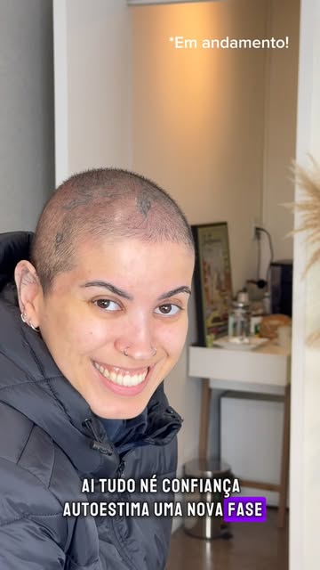 Caso de alopecia feminina com um trabalho impecável de micropigmentação capilar.
Naturalidade, preci