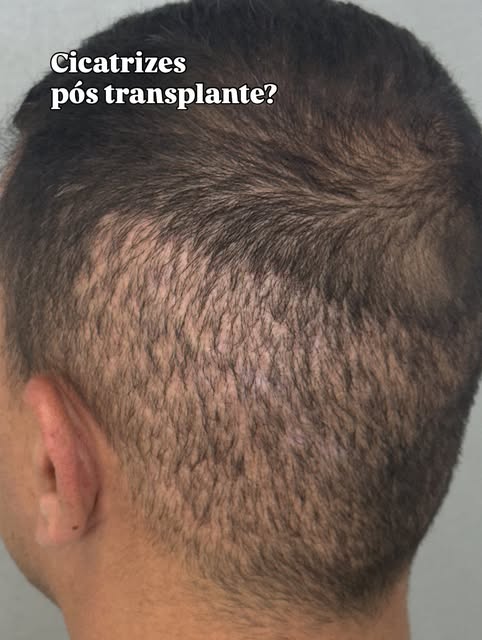 É possível trabalhar a camuflagem e devolver mais uniformidade à região, com naturalidade e precisão