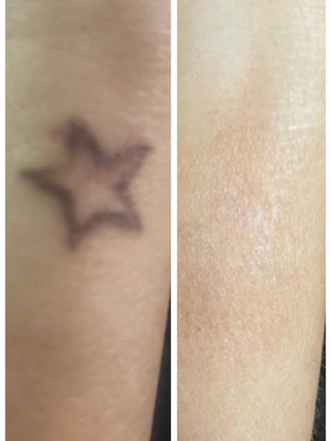 Remoção concluída com sucesso ✅

Remoção avançada com associações: 

🔹Laser + estratégia
🔹Reparo t