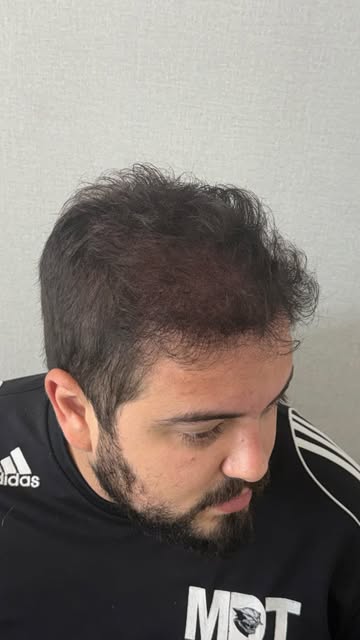 Preenchimento estratégico pós Transplante: Seu caso merece uma avaliação personalizada 🤍

Quer sabe