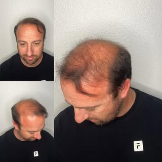 Scalp Micropigmentation (SMP) offers a solution for persistent hair loss issues like a thinning crow