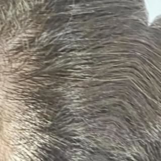 Scalp micropigmentation (SMP) has been recognized to have long lasting, self esteem boosting results