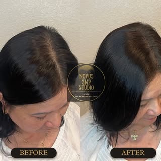 Scalp micropigmentation (SMP) has been recognized to have long lasting, self esteem boosting results