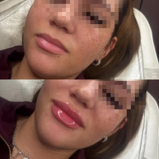 🩷1ml🩷