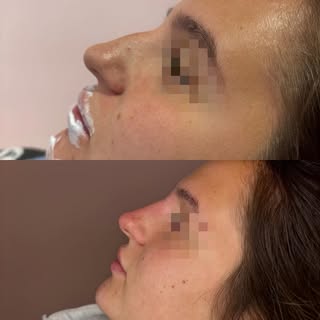 Non Surgical Nose 💉🩵