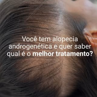 A alopecia androgenética não tem um tratamento padrão para todos.

Cada pessoa precisa de uma avalia