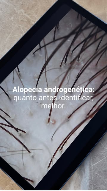 A alopecia androgenética é uma condição progressiva e, sem o acompanhamento adequado, pode evoluir a