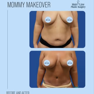 This patient wanted to restore her figure after pregnancy and achieve a more balanced, proportionate