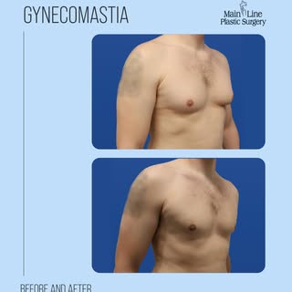 For this patient, gynecomastia surgery was about more than changing his chest, it was about feeling 