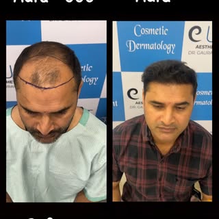 From a visibly thinning hairline to a fuller, more defined look.

This before-and-after transformati