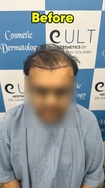A corrective hair transplant can make a big difference when the previous result didn't meet expectat