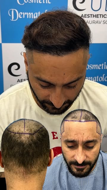 Three transformations. Three different journeys. One goal: natural-looking results.

Every hair tran