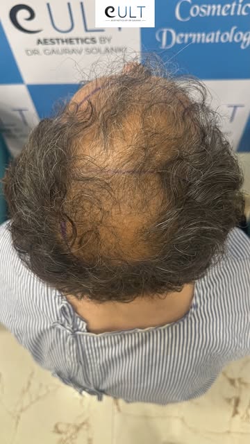 One journey. One transformation. And now, he's planning his second hair transplant. 👀

Hair restora