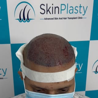 Hair transplant by Dr Ankur Lal
Another successful hair transplant designed with precision, artistic