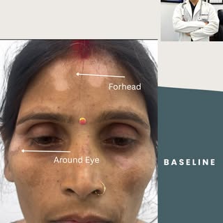 Vitiligo Treatment Results 

Visible improvement in vitiligo pigmentation with a personalized treatm