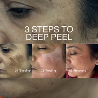 3 Steps to Deep Peel | From Pigmentation to Recovery

A well-planned chemical peel can help improve 