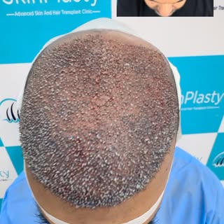 4500 Grafts. One Major Transformation. 

A high-density 4500-graft hair transplant planned to restor