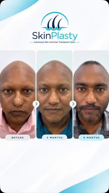Alopecia Treatment — Because Hair Loss Deserves the Right Diagnosis & Treatment

Hair fall, thinning