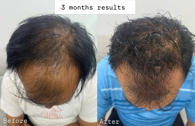 3months journey of male pattern baldness

With the right diagnosis and personalized treatment plan, 