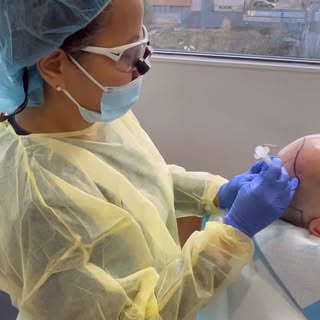 FUE hair transplant is precision in motion.
It’s not just about making sites — it’s a dance of focus
