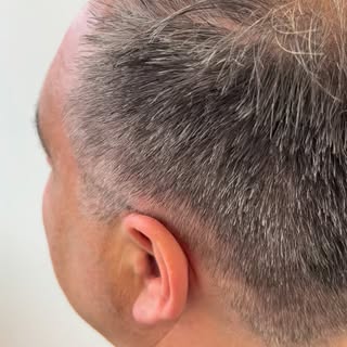 Victor, 51 yrs old
Norwood 5
2200 grafts 
November 2024