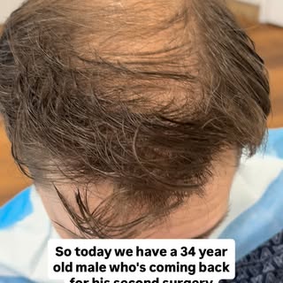 34y M
Norwood 5
1st FUE DEC 2024
3000 grafts frontal