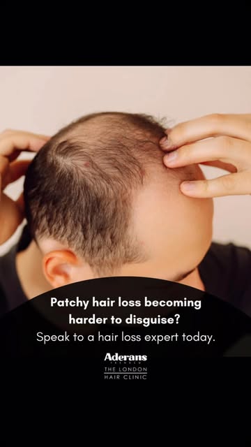 Patchy hair loss becoming harder to disguise?

If you’re constantly changing your hairstyle or worry