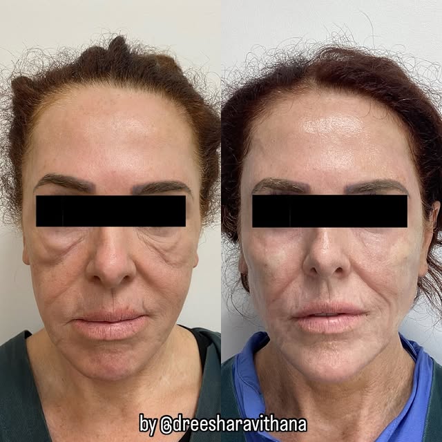 Co2 Laser Resurfacing

🩺💉 creates a controlled thermal damage to skin 
🩺💉as the body heals and r