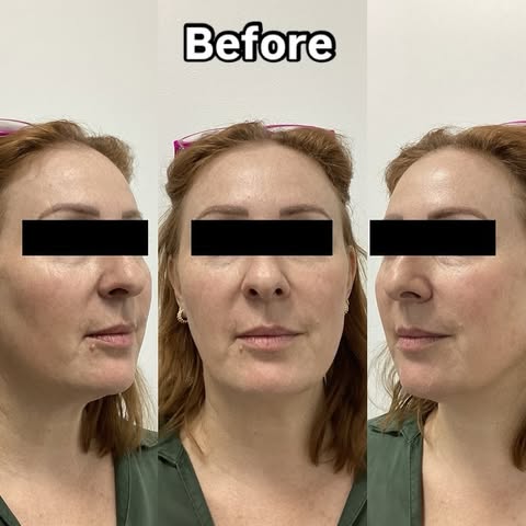 Morpheus8 

Book in to experience the Morpheus8 treatment! 

Results achieved after 3 sessions of Mo