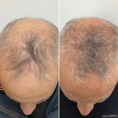 PRP + Exosomes 
This patient had 3 treatment of PRP + Exosomes. Platelet rich plasma (PRP) and Exoso