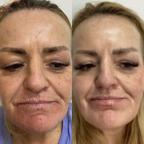 Patient had 2 sessions of Fractionated CO2 Laser & Volume Enhancements

Fractionated CO2 laser benef