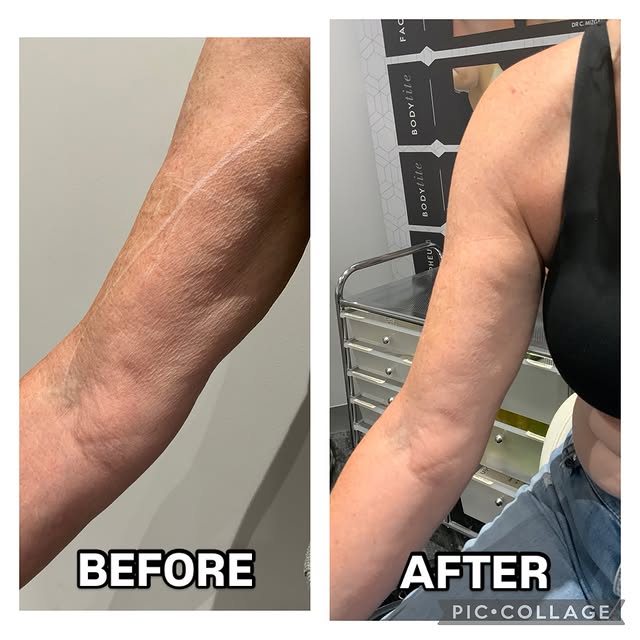 This patient had 3 sessions of Forma Plus

Benefits of Forma Plus: 
🌟 non invasive body contouring 