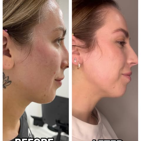 Facetite

🩺💉 minimally invasive surgery 

🩺💉 works safely in the sub-dermal plane by contracting