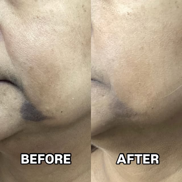 PicoSure Pro Laser 

Results achieved with 1 session. This patient had a burn, and achieved pigmenta