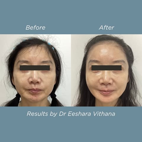 Sculptra

🌟non-surgical treatment that can be used to treat signs of ageing 

🌟sculptra is a cosme