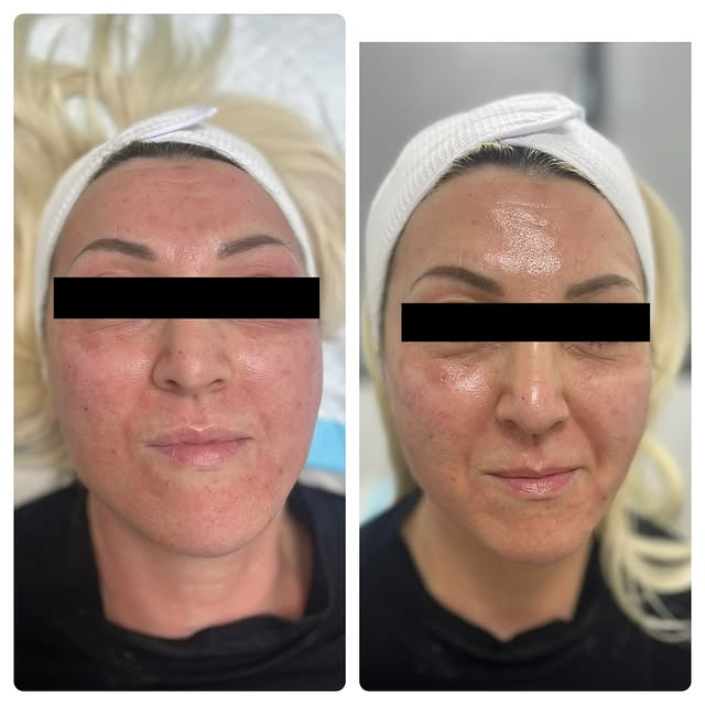 Morpheus8 

Book in to experience the Morpheus8 treatment followed by an Intraceuticals oxygen treat