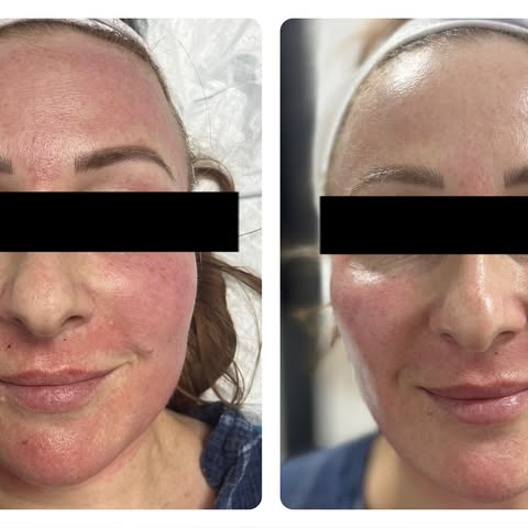 Morpheus8 

Book in to experience the Morpheus8 treatment followed by an Intraceuticals oxygen treat