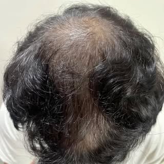 “💉 PRP Therapy for Hair Loss: Unlock the power of Platelet-Rich Plasma to naturally stimulate hair 