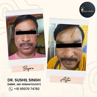 “Dive deep into the cause of melasma and discover effective management strategies. Empower your skin