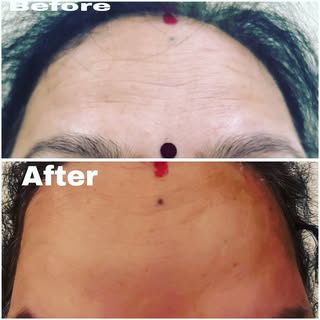 “Unlock a smoother, more youthful appearance with botulinum toxin injections. This FDA-approved trea