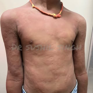 Urticaria, commonly known as hives, is a skin condition characterized by raised, itchy welts that ca