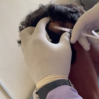 “Alopecia areata is an autoimmune condition that causes hair loss in round patches on the scalp or o