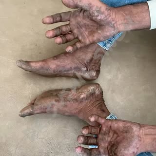Battling palmoplantar psoriasis? 🌿✨ This chronic condition features red, scaly plaques on your palm