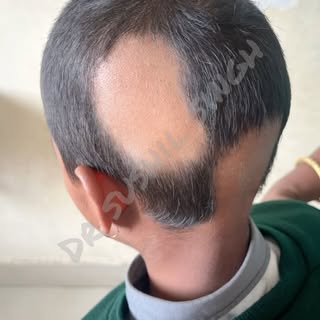Alopecia areata is an autoimmune disorder causing unpredictable hair loss, typically resulting in ro