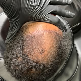 Mid-Swag in our new Glendale, California location. Serving the greater Los Angeles area!!!

Scalp Mi