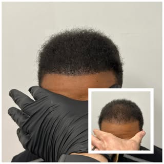 Density fill post hair transplant at Scalp King Scalp Micropigmentation located in Glendale, Califor